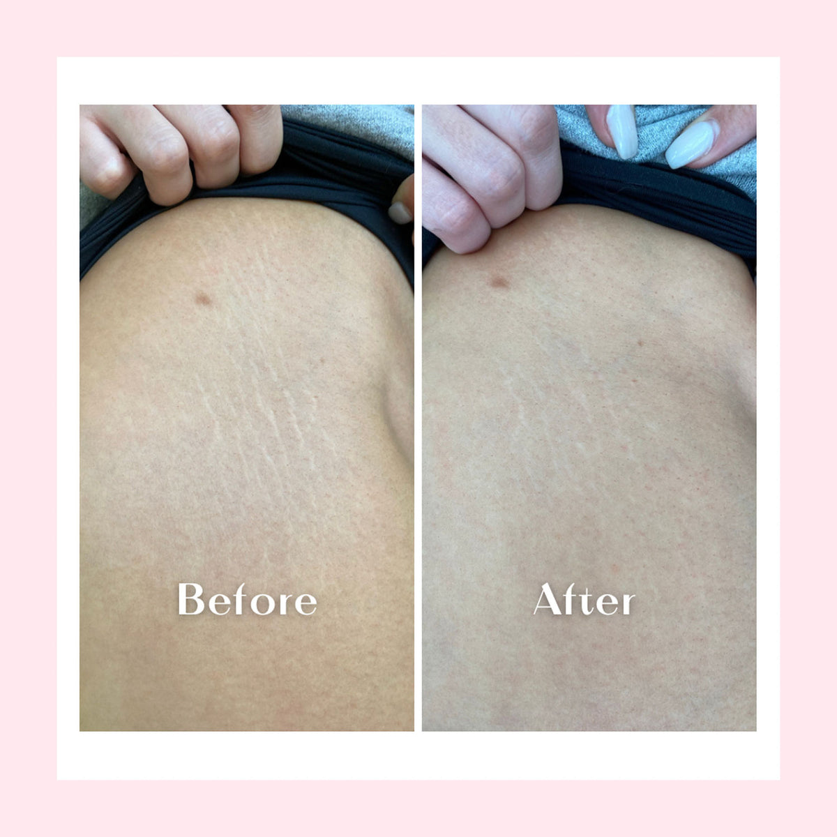 Before and After - Nakery Beauty No More Stripes Stretched Skin Oil