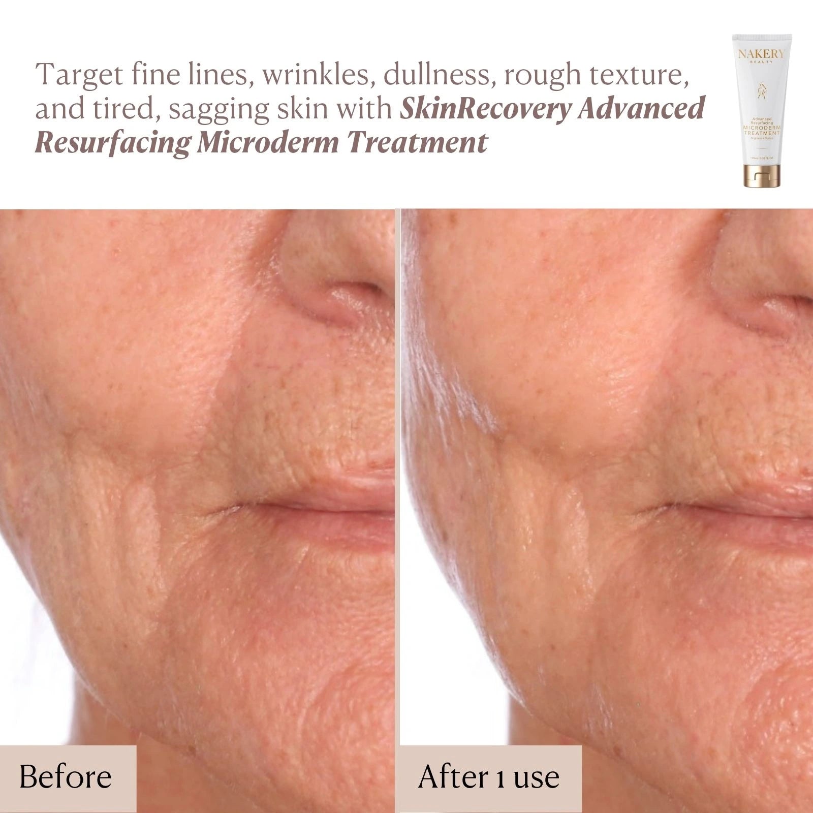 Advanced Resurfacing Microderm Treatment