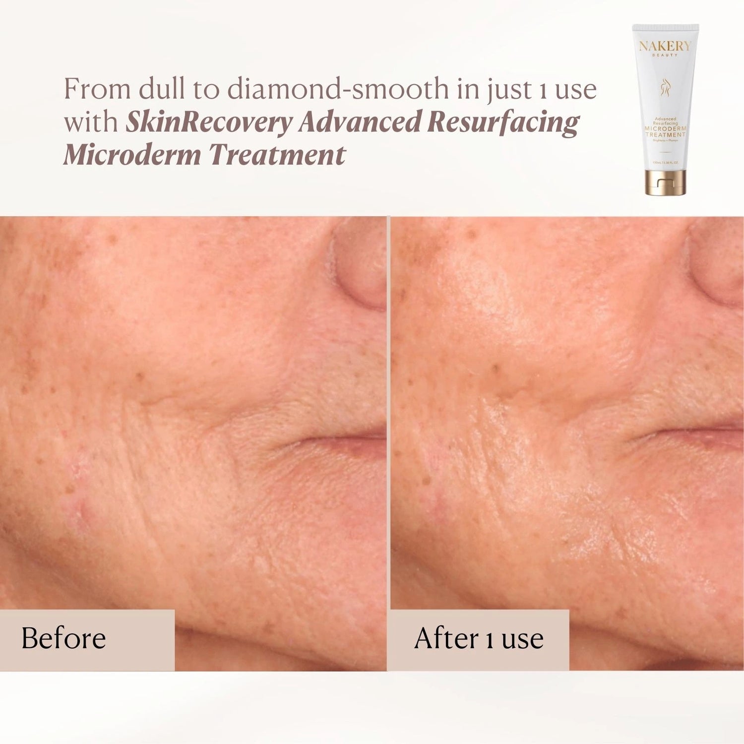 Advanced Resurfacing Microderm Treatment