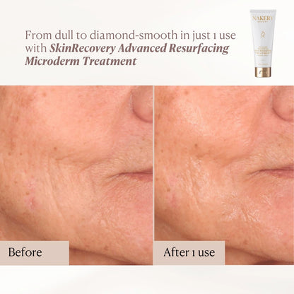 Advanced Resurfacing Microderm Treatment