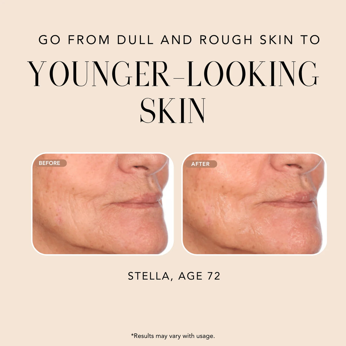 Before-and-after comparison of Stella, age 72, showing smoother, brighter, younger-looking skin after using Nakery Beauty Advanced Resurfacing Microderm Treatment.