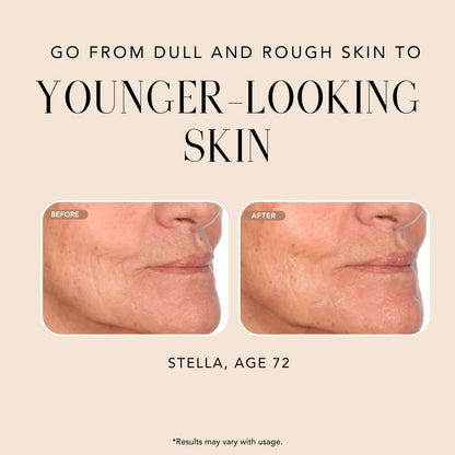 Before-and-after comparison of Stella, age 72, showing smoother, brighter, younger-looking skin after using Nakery Beauty Advanced Resurfacing Microderm Treatment.