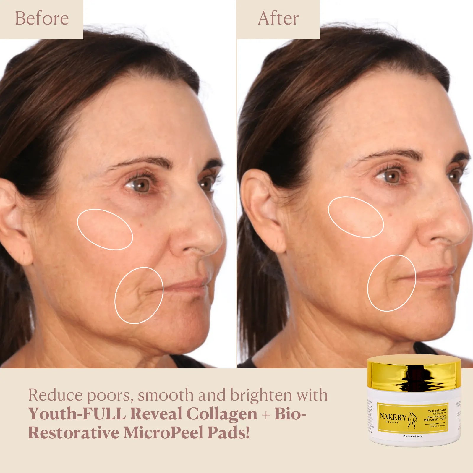 MicropeelPads - Nakery Beauty - before and after