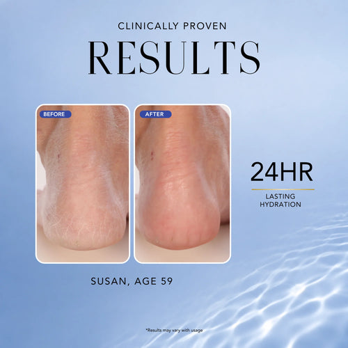 Before-and-after heel comparison showing clinically proven 24-hour lasting hydration from Nakery Beauty magnesium body care.